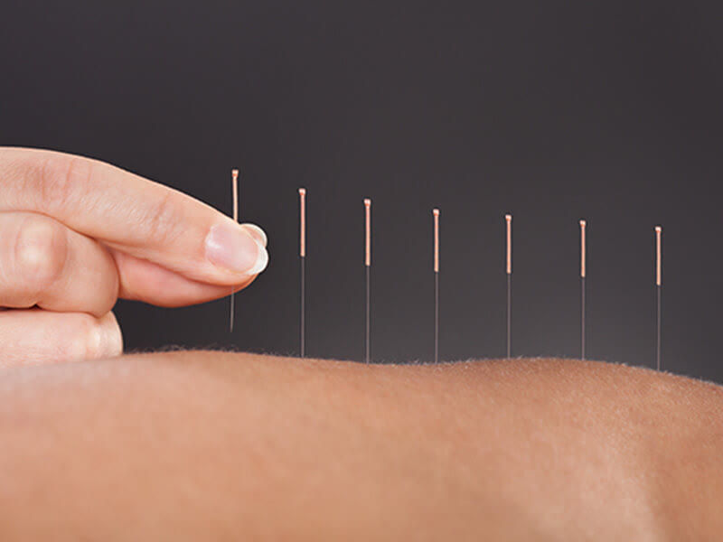 現代針灸 / Modern acupuncture needles
